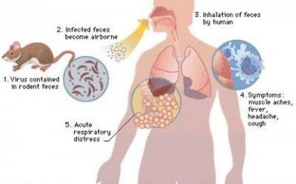 Hantavirus : les sympt&ocirc;mes apr&egrave;s exposition