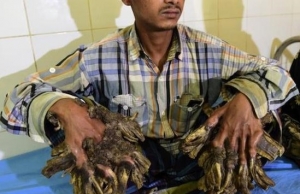 Santé : Un « homme-arbre » sera bientôt opéré au Bangladesh