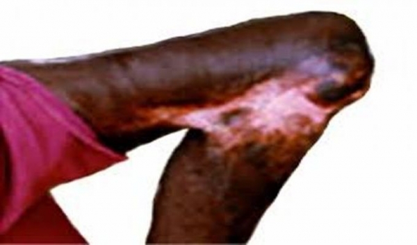 Côte d&#039;Ivoire : Plaidoyer pour une synergie d&#039;actions en vue d&#039;éradiquer l’ulcère de Buruli